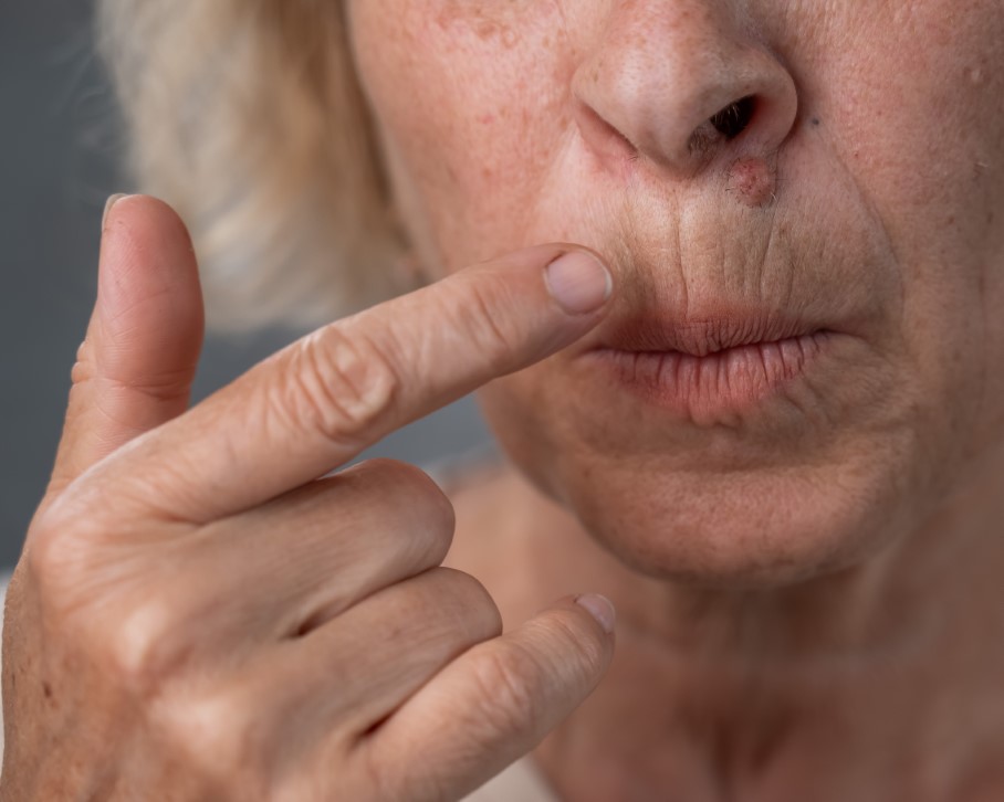 Zmarszczki palacza u kobiety wokół ust