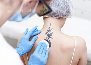 Tattoos removal