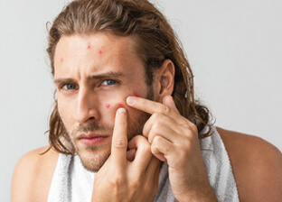 Acne Reduction for men