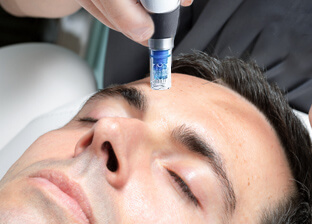 Skin micro-needling treatment (DermaPen®) for men